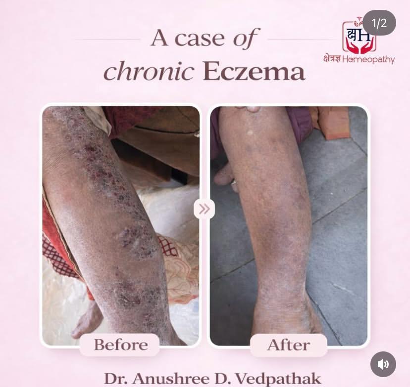 Eczema
