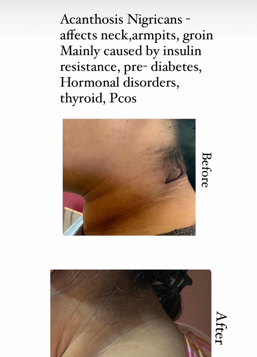 Acanthosis