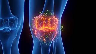 arthritis