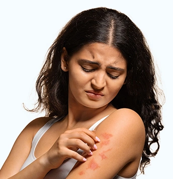 psoriasis
